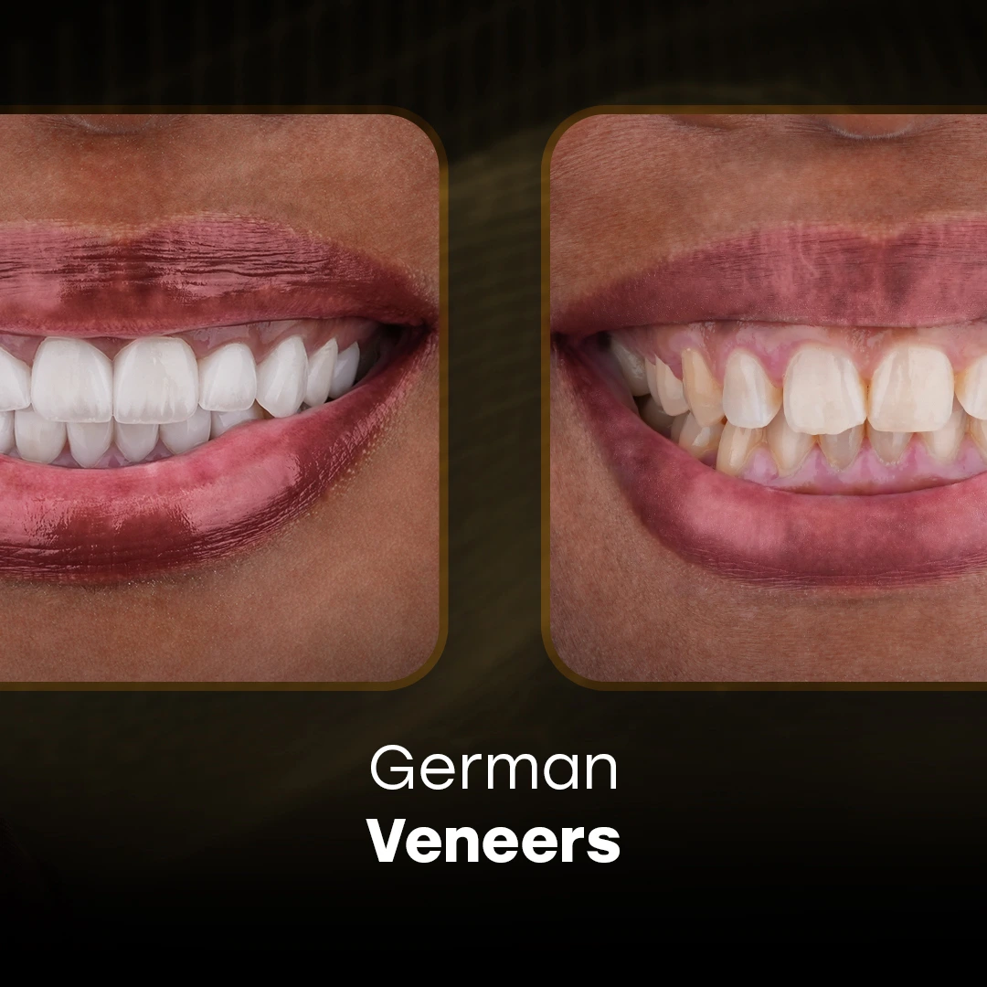 Can Veneers for Worn Teeth 3